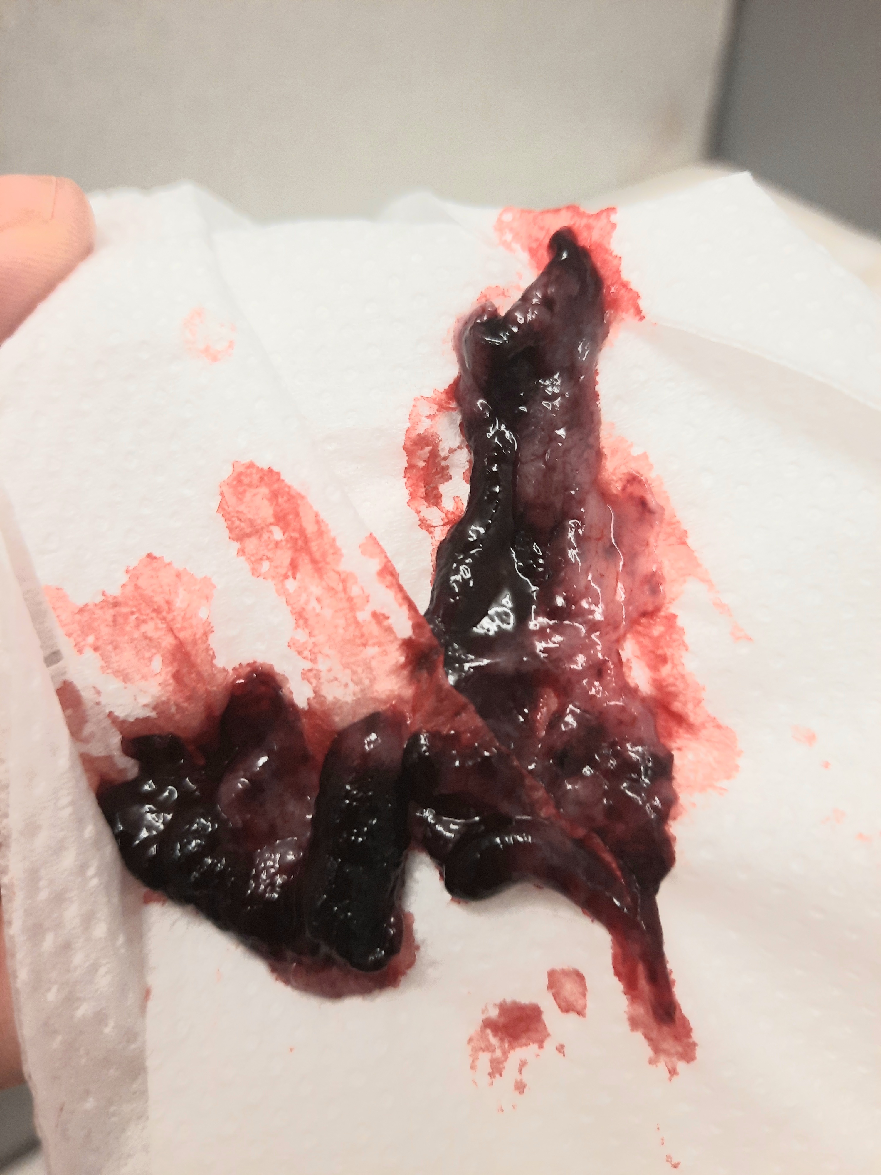 Miscarriage or blood clots? Sorry for TMI pictures